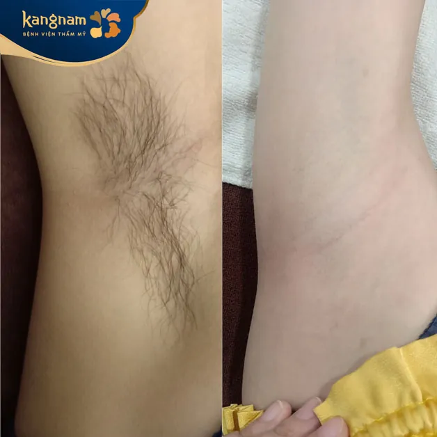 Khách hàng D.K.L (34 tuổi) triệt lông tại Kangnam Hải Phòng