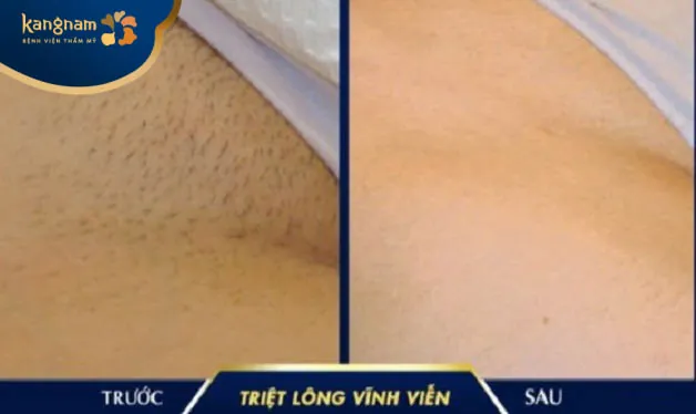 Hình ảnh khách hàng sau triệt lông vùng kín tại Kangnam