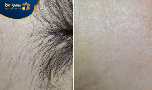 Triệt lông bikini công nghệ cao tại Kangnam