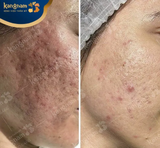 Trị sẹo lõm mức độ nặng