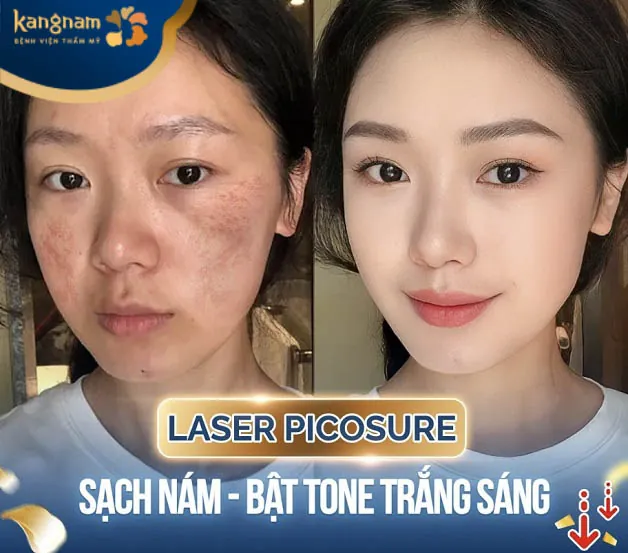 Laser Picosure trị nám, tàn nhanh nhanh chóng