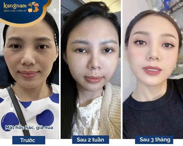 Khách hàng cấy mỡ trẻ hoá gương mặt toàn diện tại Kangnam