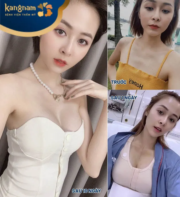 Nâng ngực tại Kangnam Cần Thơ