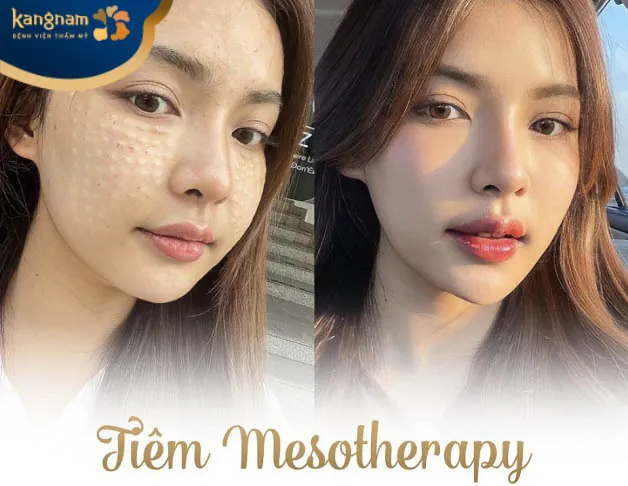 Trẻ hóa da tại Kangnam Cần Thơ