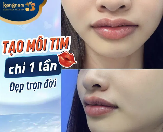 Tạo hình môi tim tại Kangnam Cần Thơ