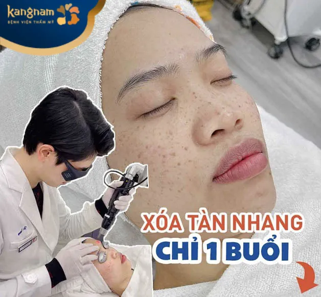 Trị tàn nhang tại Kangnam Cần Thơ