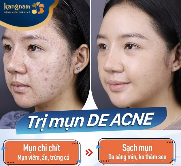 Điều trị mụn tại Kangnam Cần Thơ công nghệ De Acne