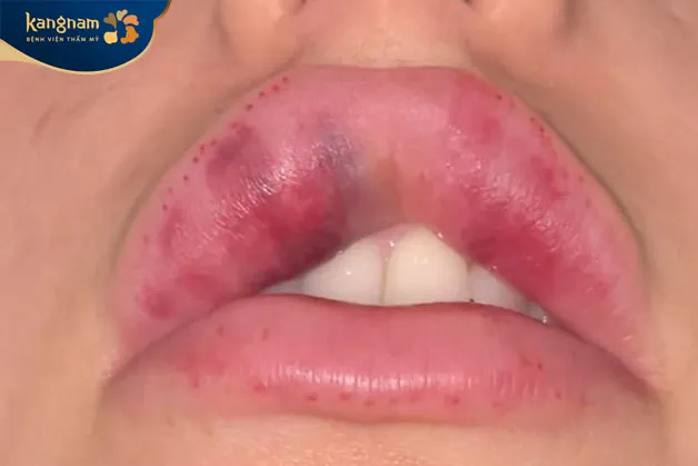 Môi sưng phù, bầm tím, không cân xứng tức là bạn đã gặp biến chứng 