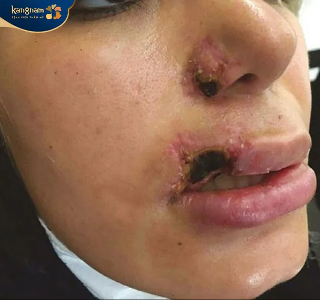 Với vùng môi bị hoại tử cần tìm đến bệnh viện để loại bỏ 