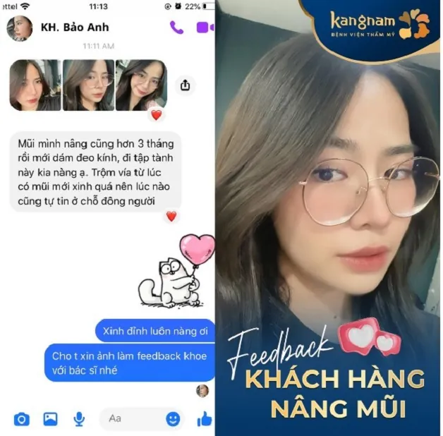 Khách hàng Bảo Anh sau 3 tháng thực hiện nâng mũi tại Kangnam