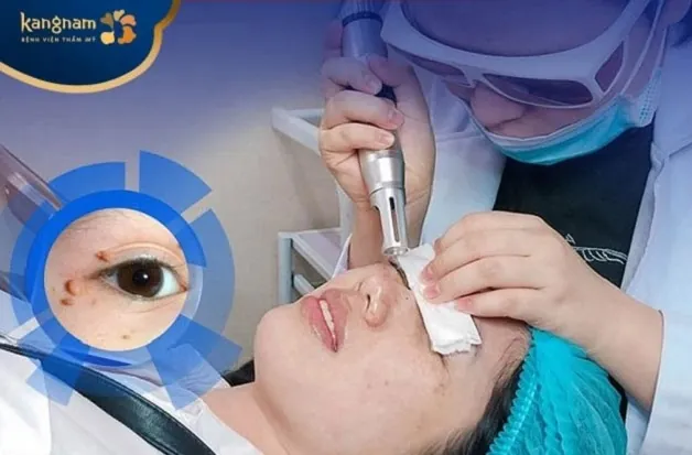 Dịch vụ Điều trị mụn thịt/mụn cơm Laser CO2 Fractional