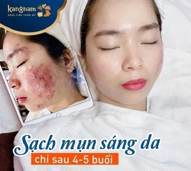 Cam kết sạch mụn sáng da chỉ sau 4-5 buổi điều trị