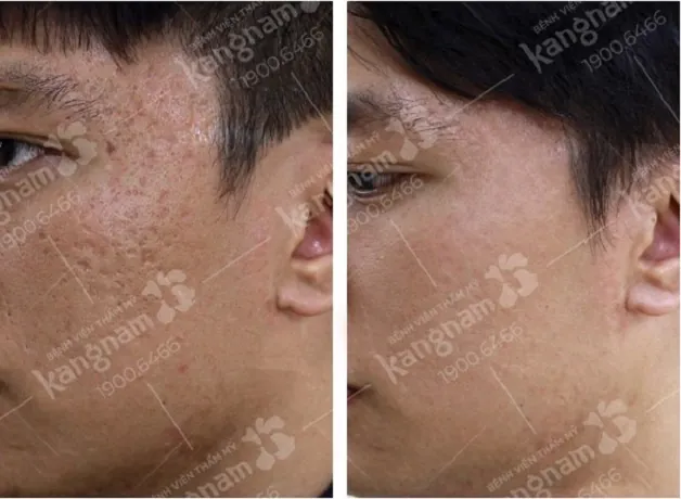 Làn da thay đổi rõ rệt và đều màu hơn