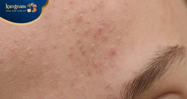 Mụn ẩn không có nhân xuất hiện nhiều ở vùng trán