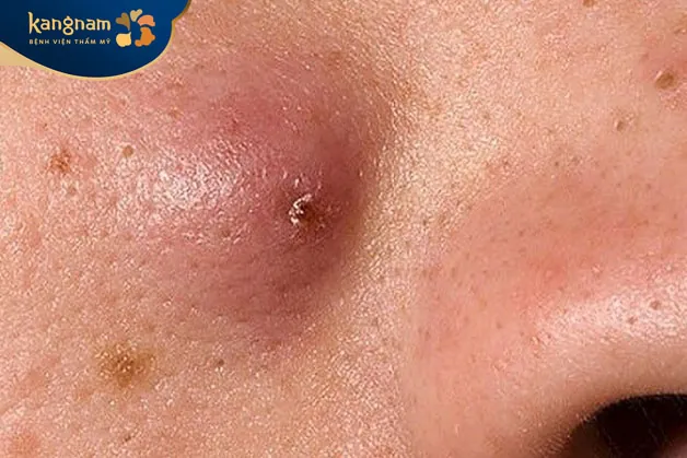 Mụn đinh râu được đánh giá là không nguy hiểm