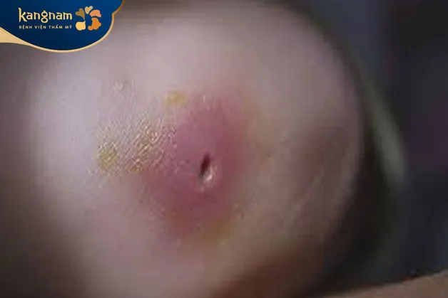 Giai đoạn 3: Mụn đinh râu thoát mủ