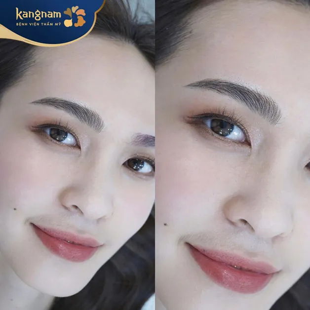 Sửa lại lông mày bong sau khoảng 3-5 ngày