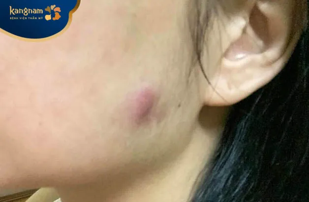 Vết áp xe tại vùng tiêm botox