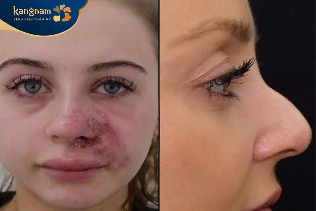 Tiêm filler mũi có thể ảnh hưởng đến vùng mắt