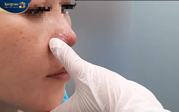 Mụn viêm, mụn mủ hình thành do tác dụng phụ khi tiêm filler cần cẩn thận điều trị