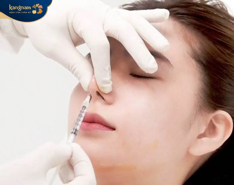 Tiêm filler mũi duy trì được từ 6 - 24 tháng