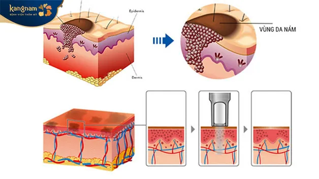 Không chỉ trẻ hóa da, công nghệ Laser Q - Switched còn giúp xóa hình xăm hiệu quả 