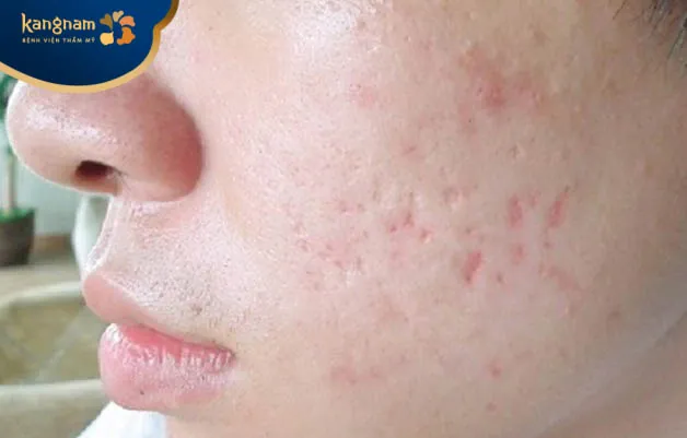 Sẹo lõm hình thành do thiếu hụt mô dưới da