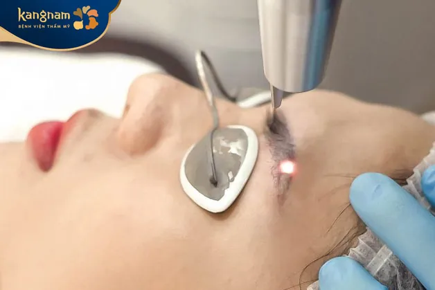 Xóa xăm bằng laser