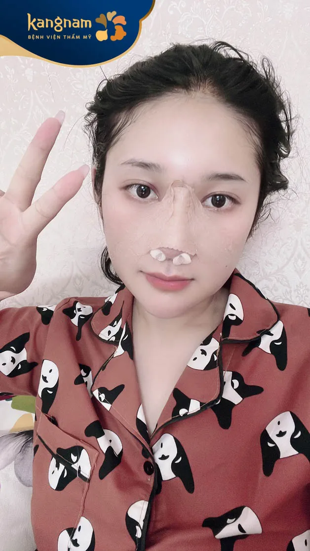 7 ngày sau phẫu thuật