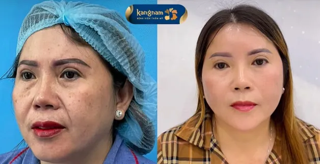 Kéo căng vòng da mặt chảy xệ, trẻ hóa làn da toàn diện