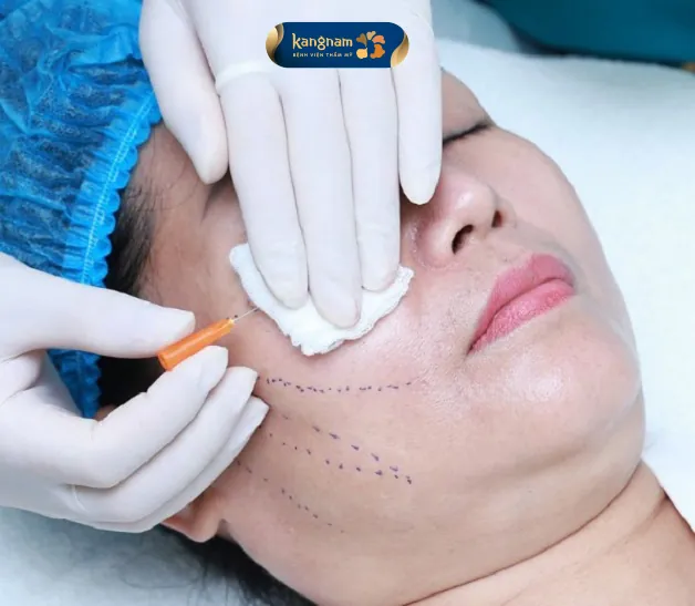 Chỉ Mono được cấy vào dưới da sẽ tạo lớp màng mỏng nhẹ nâng đỡ vững chắc cấu trúc da