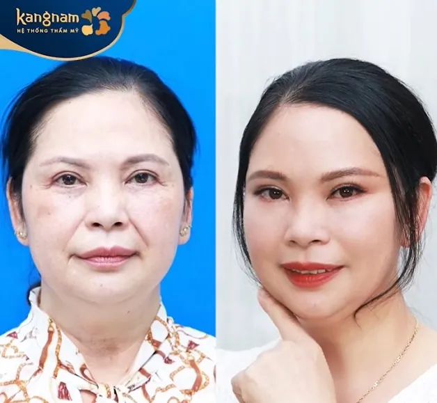 Gương mặt thon gọn, mờ nếp nhăn, da căng bóng