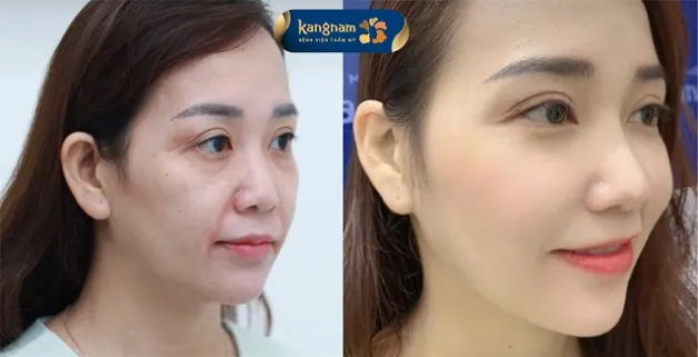 Da căng mịn, loại bỏ rãnh cười sau căng chỉ