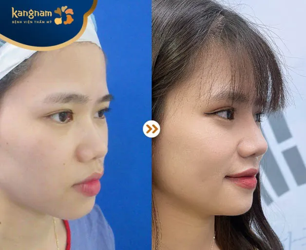 Mũi đẹp giúp gương mặt tươi tắn, hài hòa đường nét