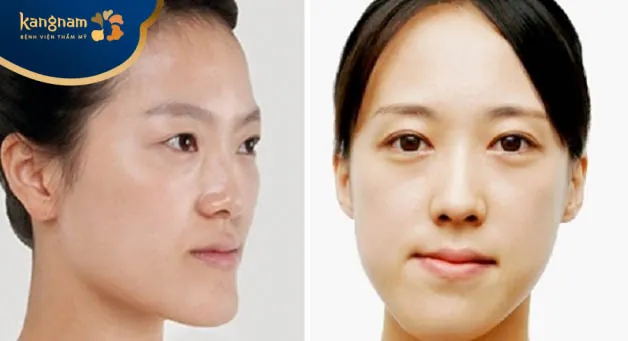 Không nên lựa chọn địa chỉ tiêm botox giá rẻ, kém chất lượng để tránh biến chứng