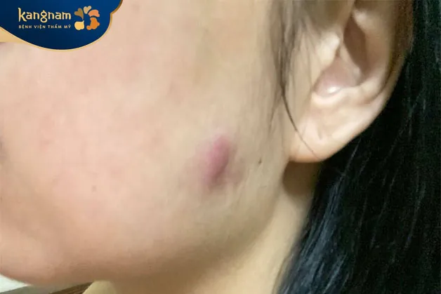 Việc tiêm botox thon gọn hàm khi chưa đủ tuổi dễ gây ra nhiều rủi ro