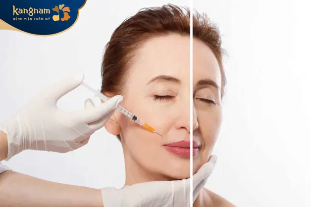 Lượng cc filler cần sử dụng