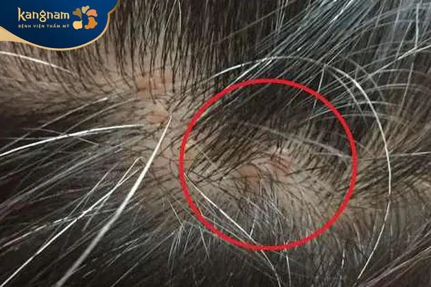 Mụn mủ và mụn nhọt