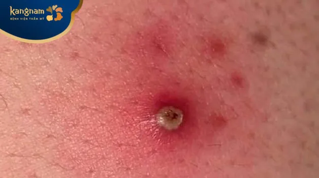 Chân bị mọc mụn đinh râu có nguy hiểm không?