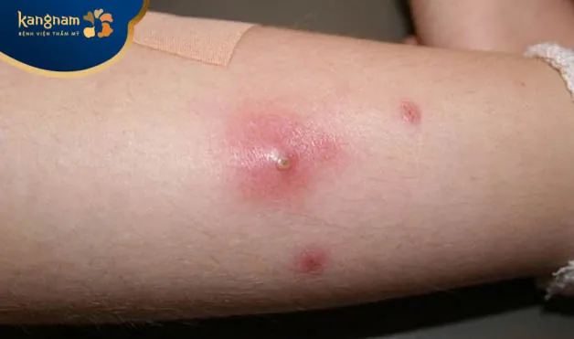 Mụn đinh râu mọc ở bắp chân