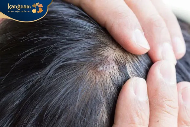 mụn bọc mọc ở trên da đầu có nhiều nguyên nhân và yếu tố kết hợp lại
