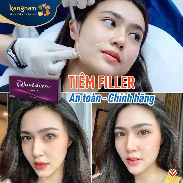 Kangnam ưu tiên dùng filler chất lượng cao