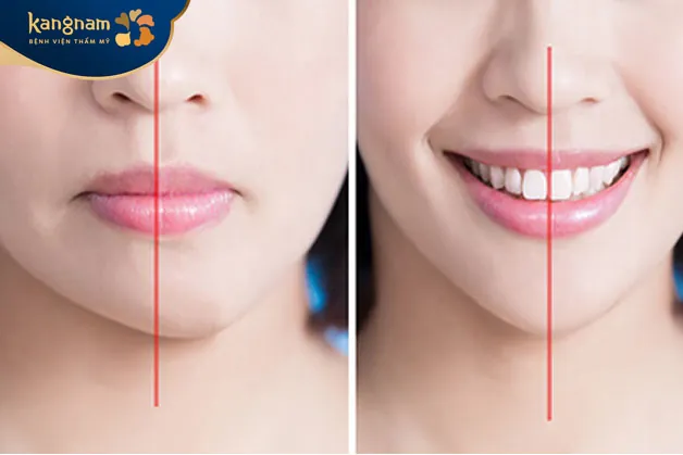 Tiêm filler mặt lệch dao động trong khoảng từ 5 - 15 triệu đồng