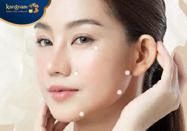 Tiêm trẻ hóa Tiêm Profhilo ứng dụng kỹ thuật tiêm B.A.P (Bio Aesthetic Points)