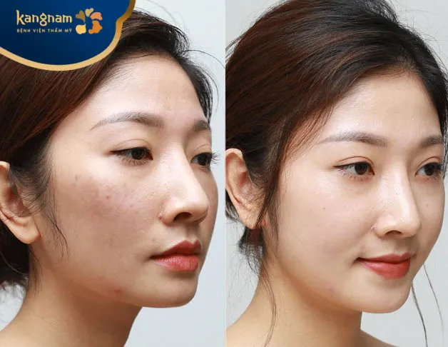 Những người nên tiêm meso trắng da