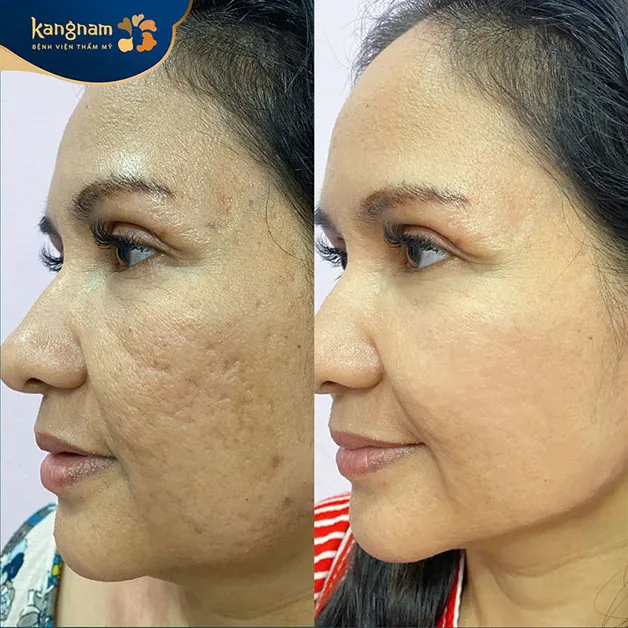 Xóa sẹo rỗ nhanh chóng, da mịn màng và đều màu hơn