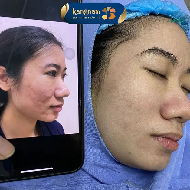 Làn da mịn màng, sáng khỏe hơn sau liệu trình trị sẹo