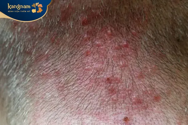 Có vết sưng nhỏ lan xuống trán hoặc sau gáy