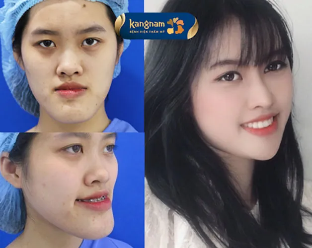 Chỉnh sửa hàm móm tại Kangnam áp dụng kỹ thuật tiên tiến BSSO