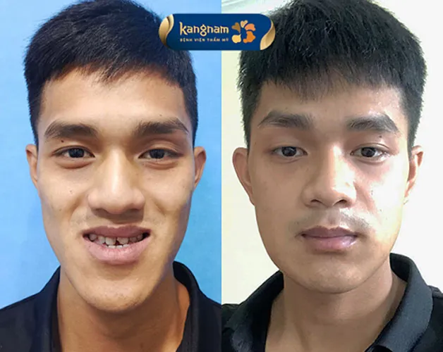 Gương mặt cân đối và hài hòa hơn sau khi khắc phục tình trạng hàm móm